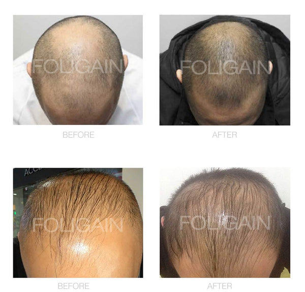 FOLIGAIN Minoxidil 5% Hair Regrowth Treatment For Men 12 Month Supply - FOLIGAIN EU