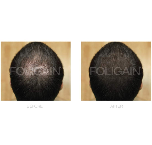 FOLIGAIN Low Alcohol Minoxidil 5% Hair Regrowth Treatment For Men 6 Month Supply - FOLIGAIN EU